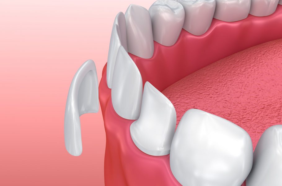 Коррекция прикуса винирами